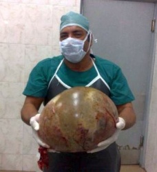 Индийские врачи извлекли из тела подростка 20-килограммового паразита-близнеца